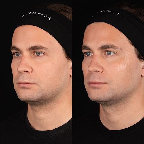 Teoxane babyGLOW™ for HIM Before & Afters